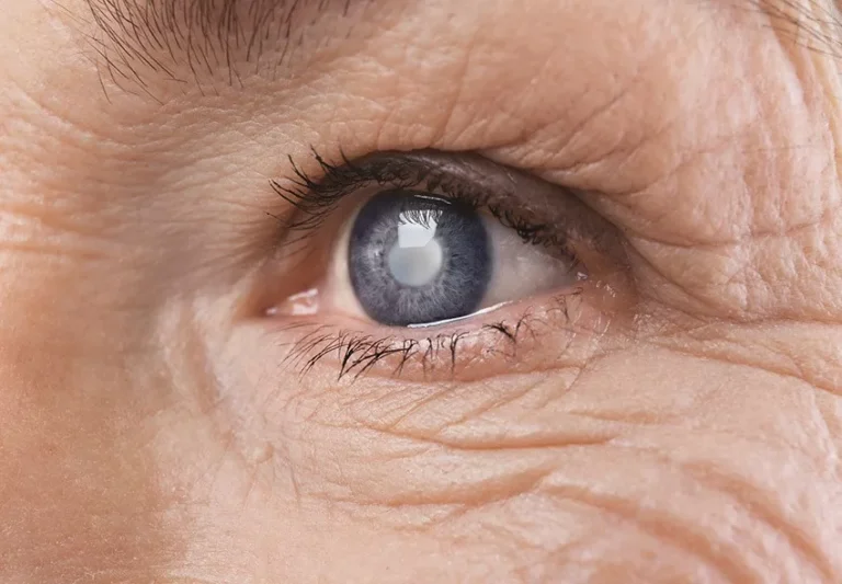 4 Factors That Affect Cataract Development