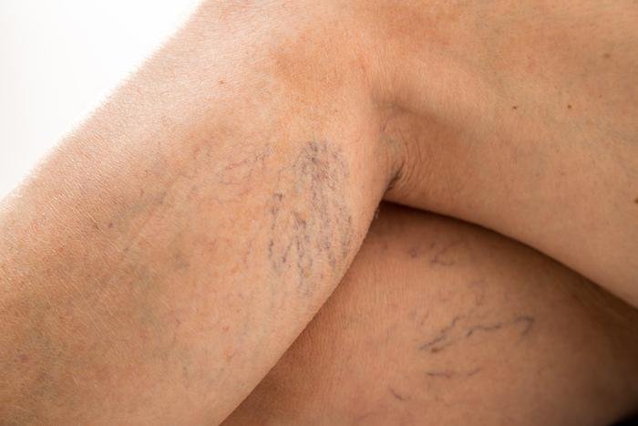 Spider Vein Removal: How to Get Rid of Unsightly Veins