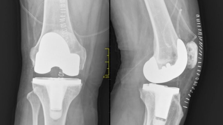 What to Expect Before, During, and After Total Joint Replacement