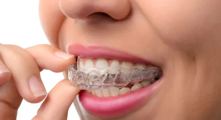 Why Adults Are Opting for Orthodontic Treatment More Than Ever