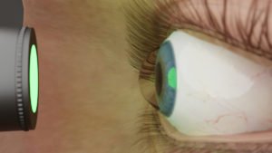 What is Corneal Cross-Linking and How Does It Improve Vision