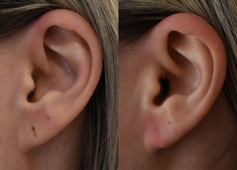 How Painful is Earlobe Repair Surgery?