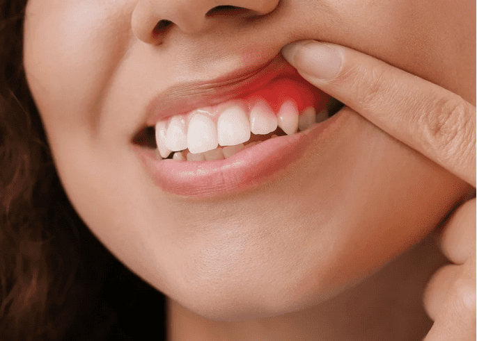 The Role Of Dental Cleanings In Preventing Gum Disease