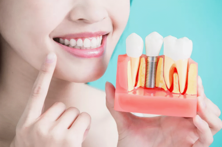 How To Care For Your Dental Implants After Surgery