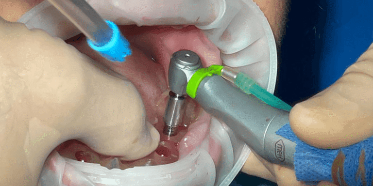 Guiding Patients Through The Dental Implant Journey In A Family Practice Setting